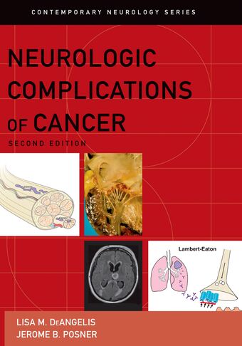Neurologic Complications of Cancer book cover