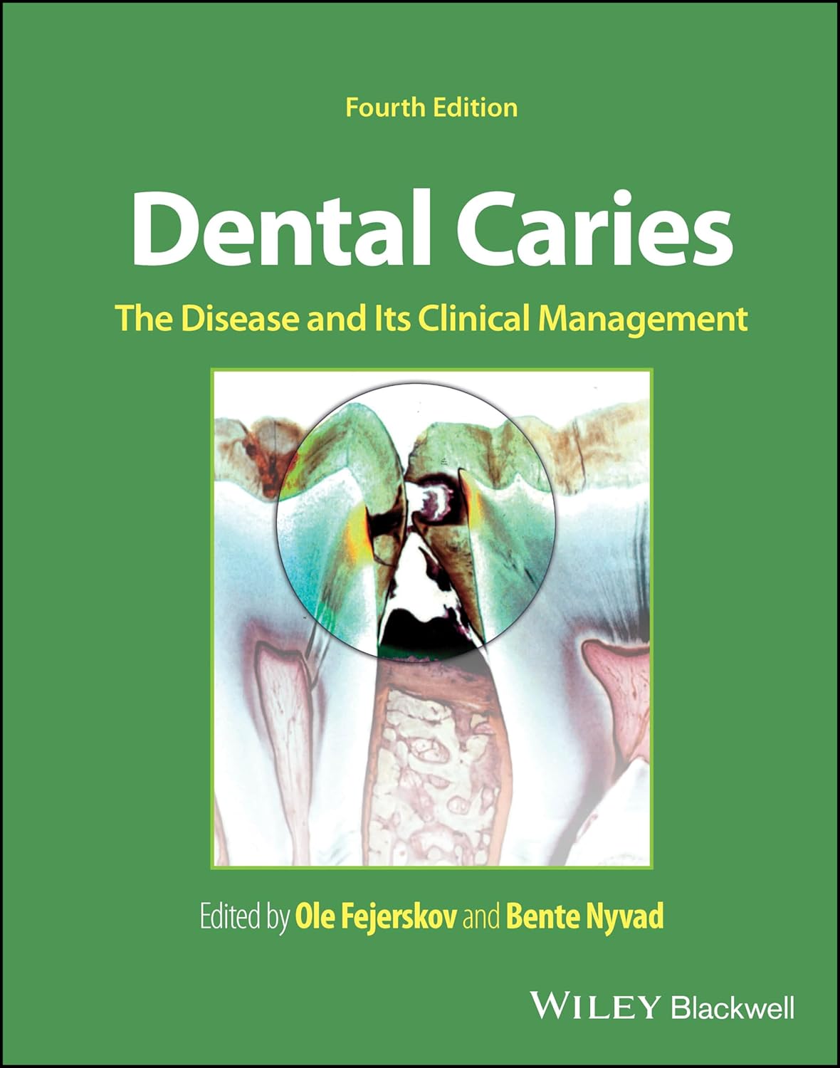 Dental Caries: The Disease and its Clinical Management cover
