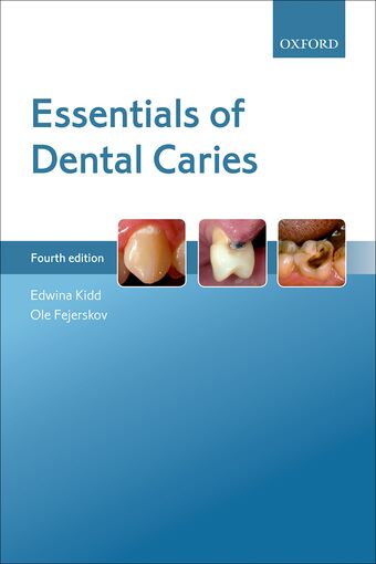 Essentials of Dental Caries book cover