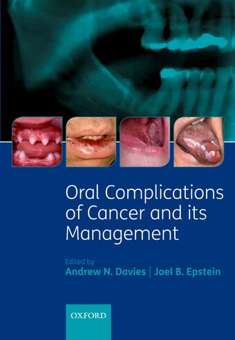 Oral Complications of Cancer and its Management book cover