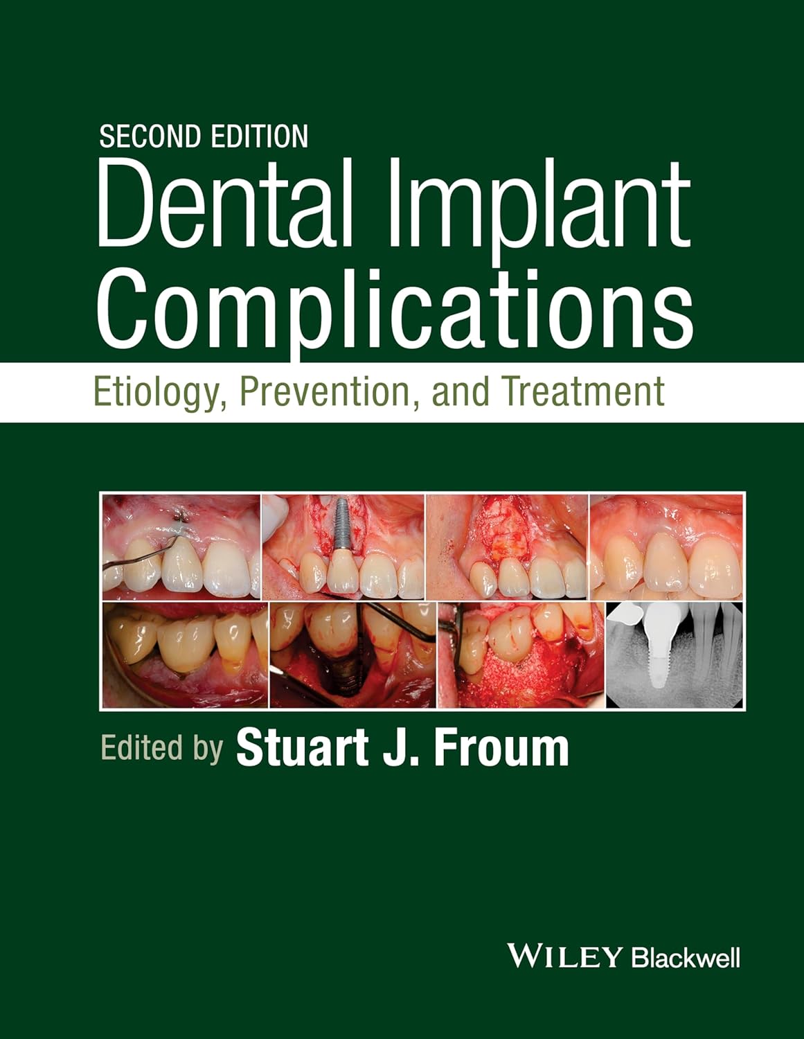 Dental Implant Complications: Etiology, Prevention, and Treatment cover