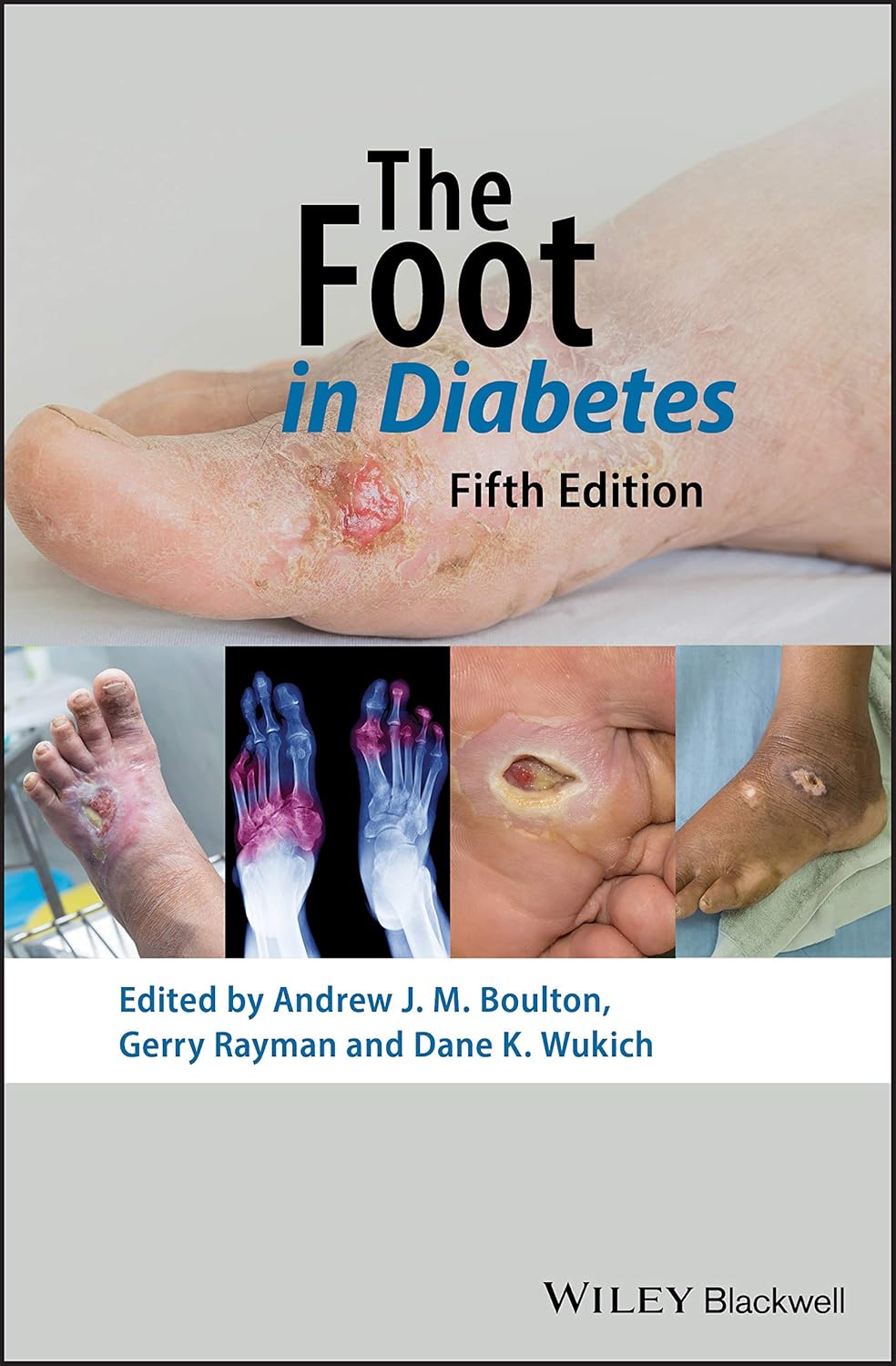 The Foot in Diabetes